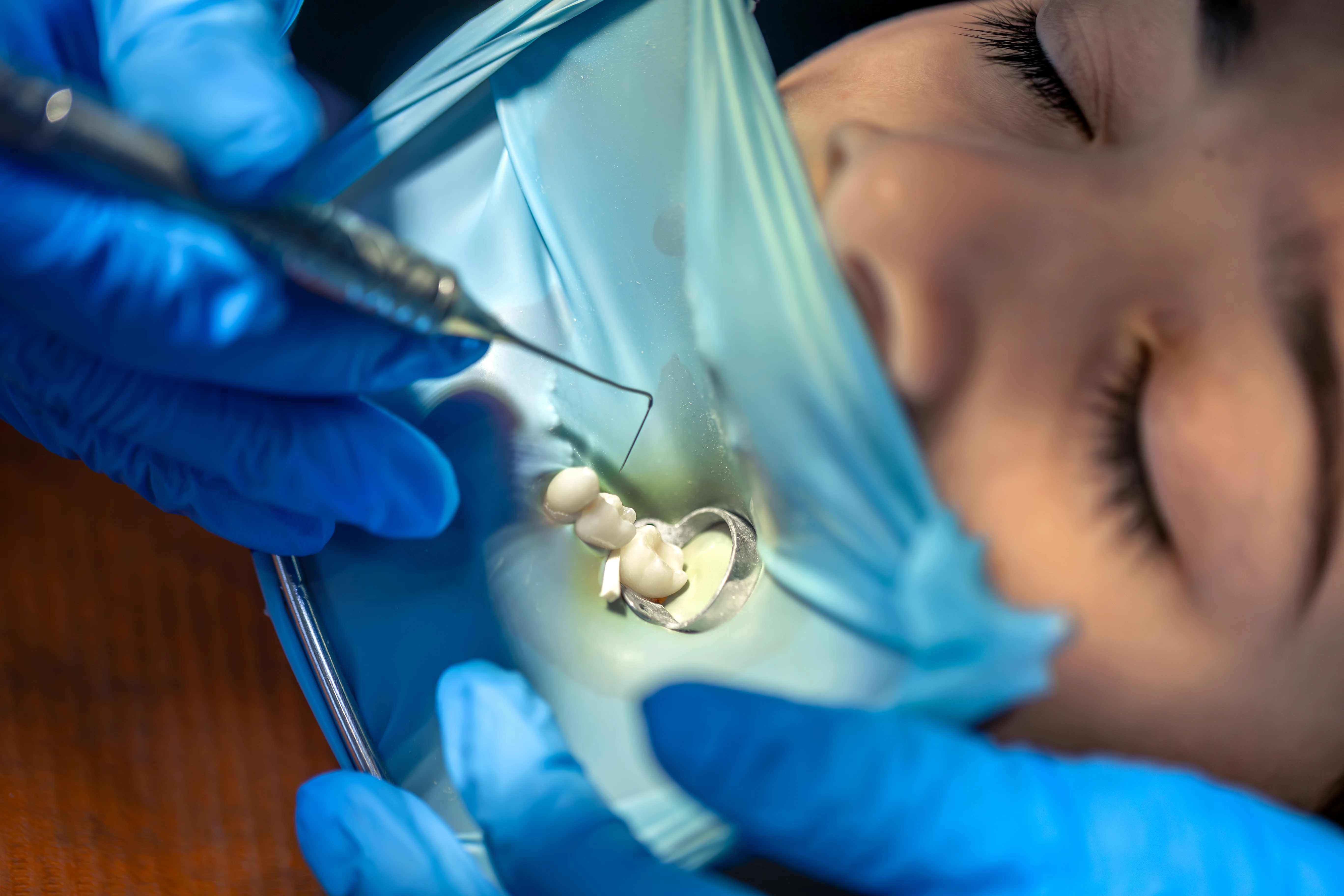 Root Canal